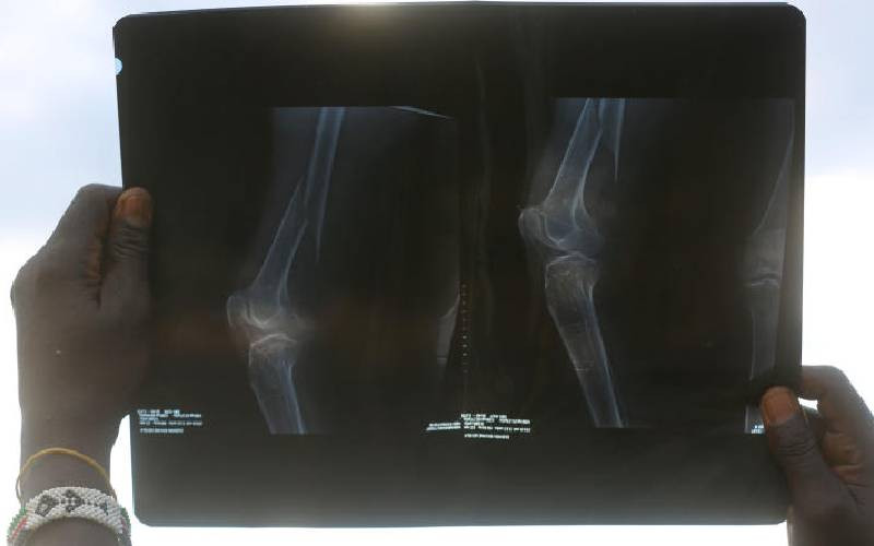 Oestrogen drop leaves postmenopausal women vulnerable to bone disease
