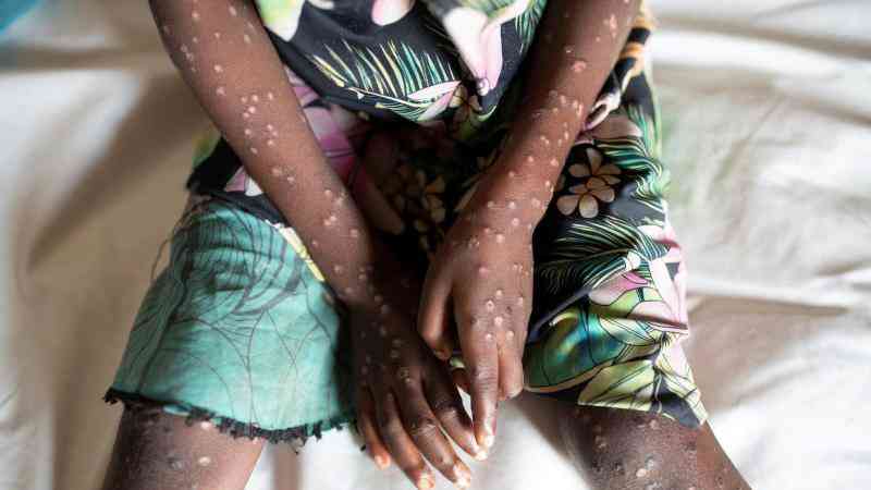 There is need for concerted action to tackle Mpox's spread