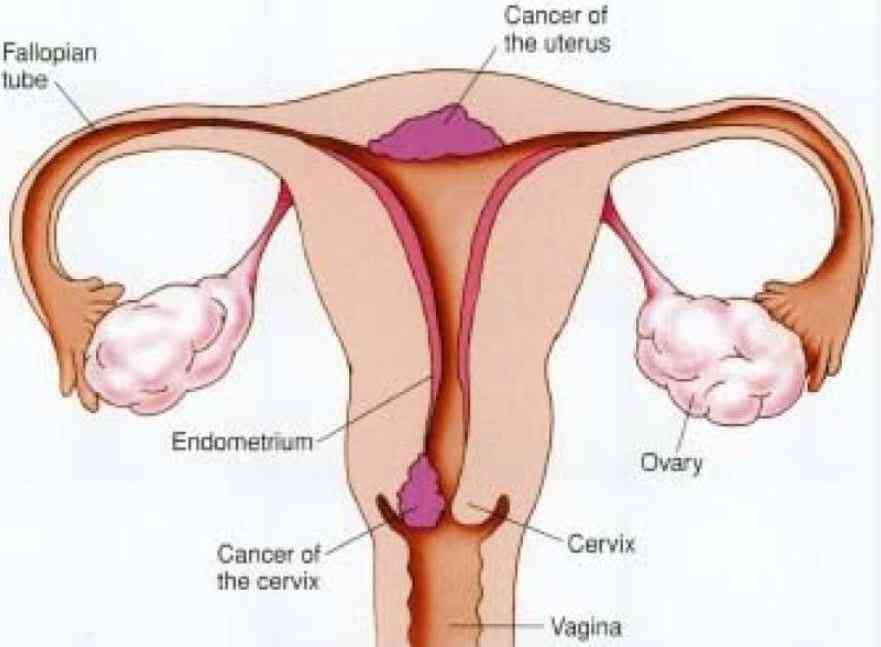 State rolls out five-year plan to fight cervical cancer