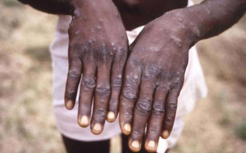 Sudan detects first case of monkeypox in Darfur
