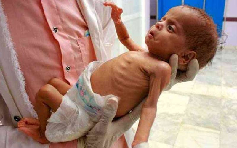 Malnutrition remains a challenge among children under five in Baringo