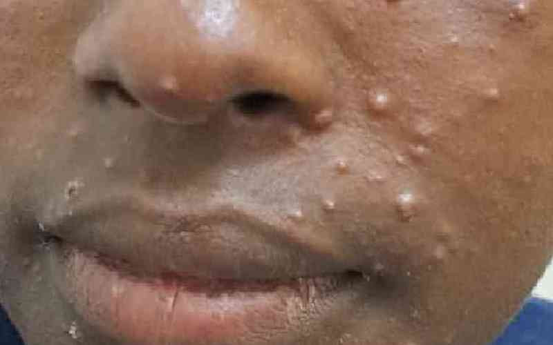 Kenya confirms third Mpox case...