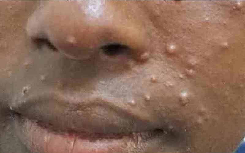 Mombasa records two Mpox deaths, 98 new cases