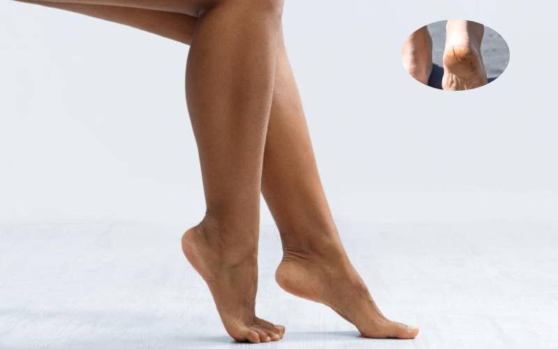 How to soften cracked heels