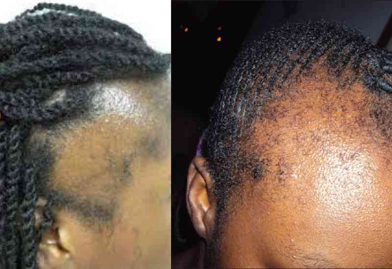 Traction alopecia from braids and manbraids hairstyles