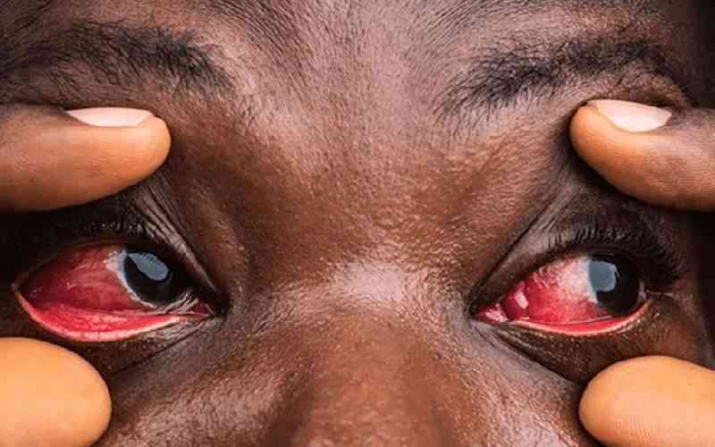 Malawi's viral conjunctivitis outbreak surges to 13,400 cases