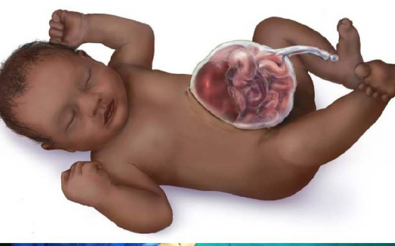 Omphalocele: When babies are born with organs outside the body