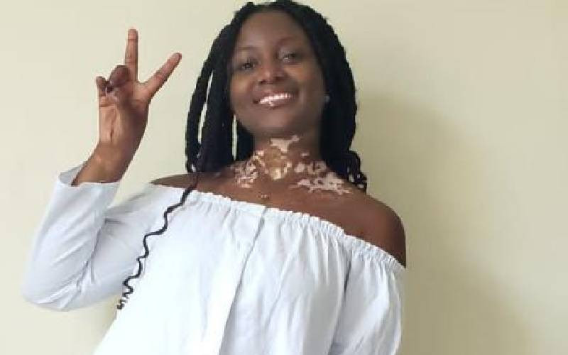 Elizabeth Mwikali: I wasn't burnt by acid, I have vitiligo