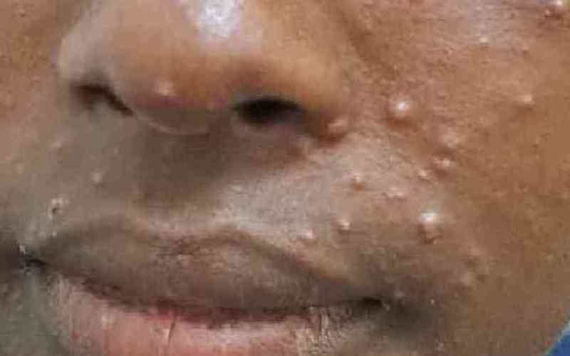 One dead as Kenya Mpox cases h...