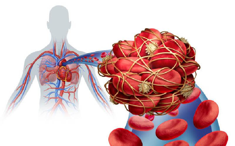 Venous thrombosis: When inactivity leads to clotting