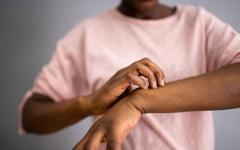 Nancy Waweru: Cold urticaria robbed me of my sleep