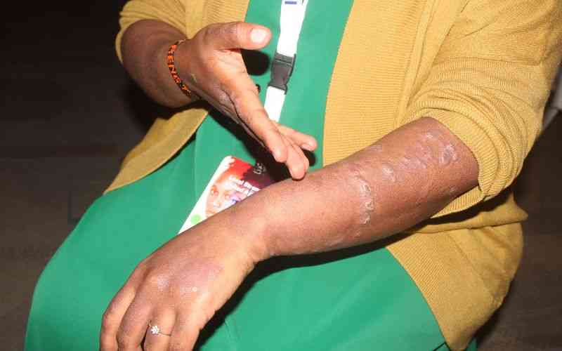Psoriasis: The skin condition Kenya's health system continues to ignore