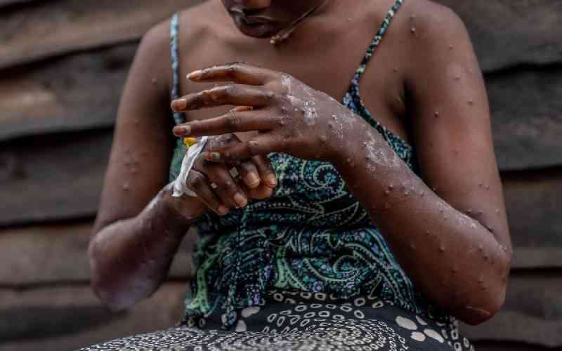 Experts blame relaxed restrictions as Mpox cases rise in Mombasa