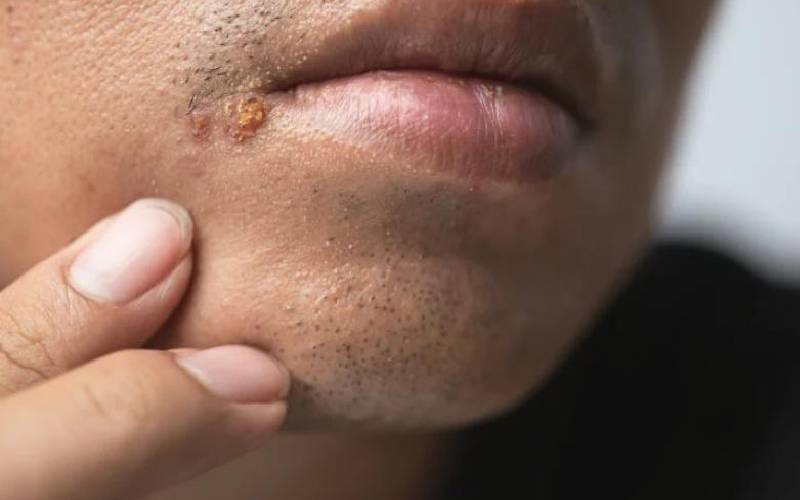 Say goodbye to cold sores: Practical advice for prevention and treatment