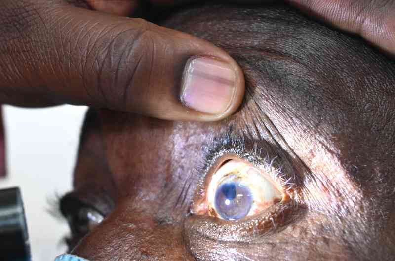 Red eye disease: What you need to know