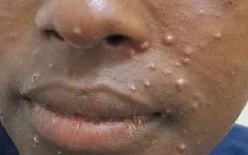 Mpox cases rise in DR Congo as country awaits vaccines