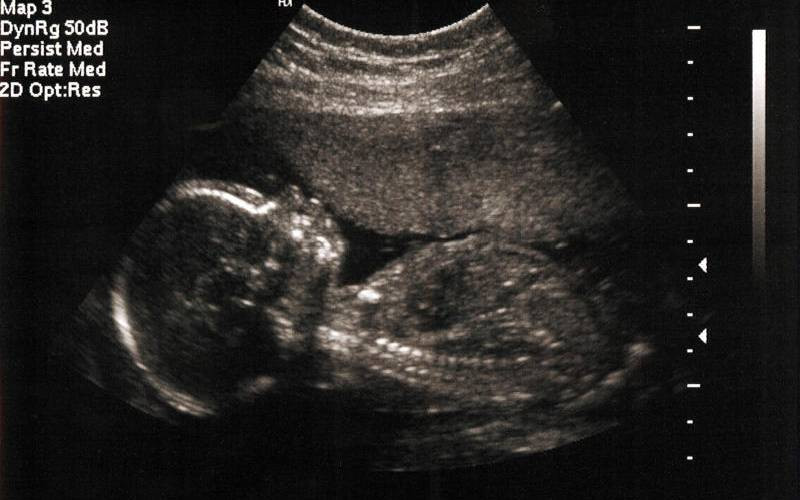 Stillbirths: The psychological and physical toll on expectant mothers