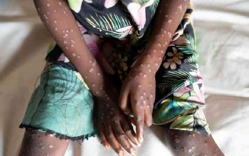 Laikipia, Nyandarua on high alert as Mpox cases confirmed