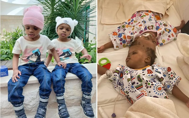 AI-powered surgery separates conjoined Nigerian twins in 40-hour operation