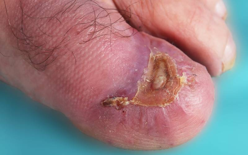 Personalised cancer vaccine cuts melanoma recurrence risk in trial