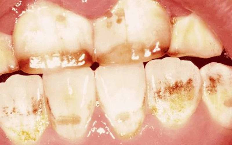 Fluorosis poses a challenge to oral health in Nakuru