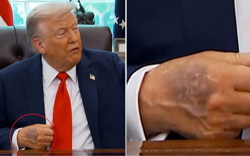 Bruises on Donald Trump's right hand elicit concern over his health