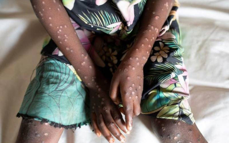 Kenya confirms 314 Mpox cases across 22 counties