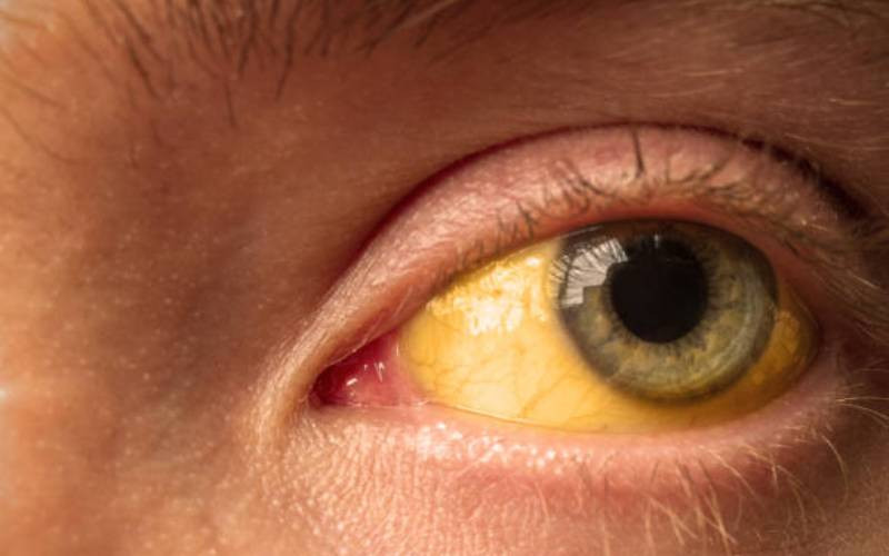 My eyes, skin turned yellow, I was diagnosed with adult jaundice!