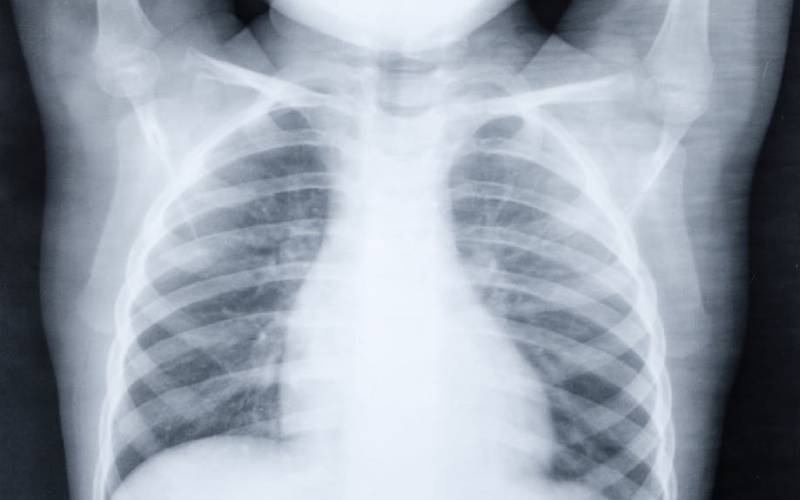 Pneumonia Kenya’s leading killer disease in children