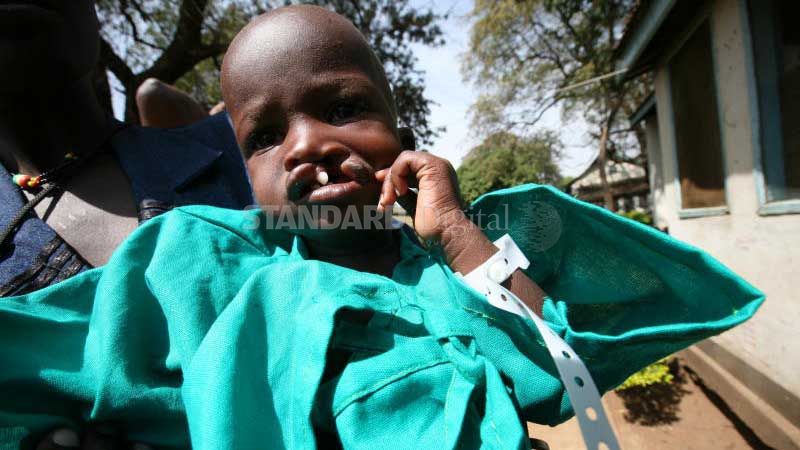 Cleft lip and palate need not be death sentences for patients