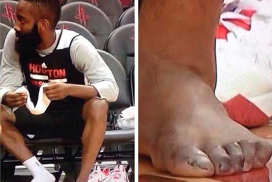 Real Reason Basketball Players Have Messed Up Feet   Thumb Srqxsnovyr1firupals5b156515881fe 