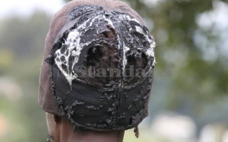 The Feb. 13 fire slightly burnt his prized locks.