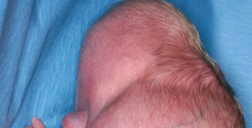 newborn misshapen head