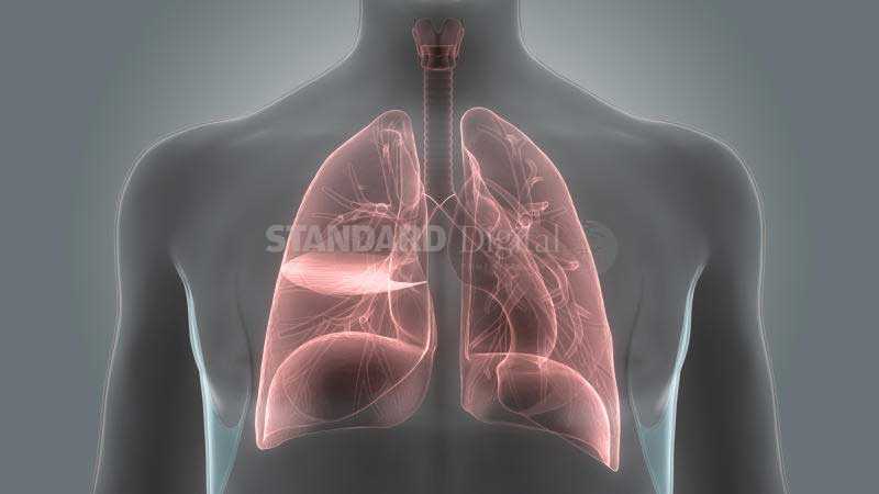 Cost of treating drug resistant TB hits the roof