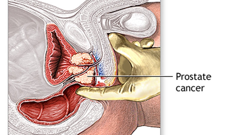Reduce chances of prostate cancer by simple diet tweaks