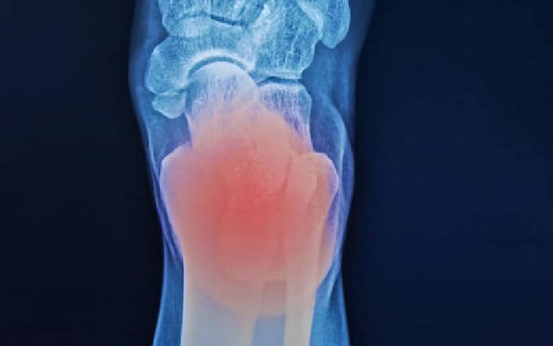 Arthritis: Occurs over time, appears suddenly      