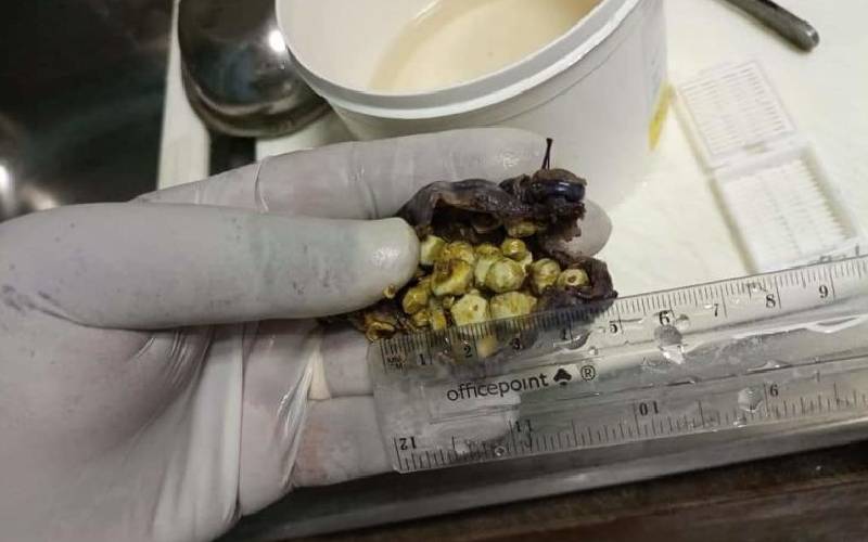 gallstones in poop