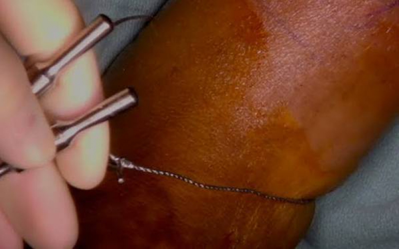 Medic to testify in pupil's queer amputation