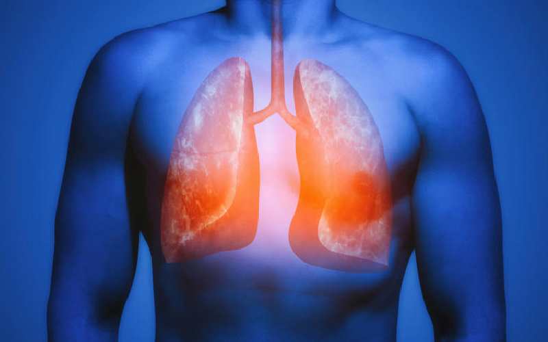Why we are engaging TB clinics in the battle against lung cancer