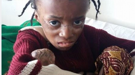 Kenyans online rescue girl with rare skin disease