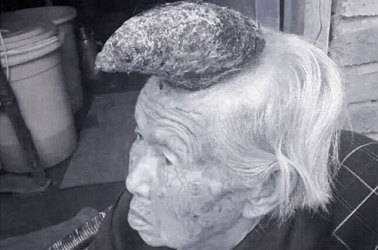 Woman with horn on her head set for removal operation 