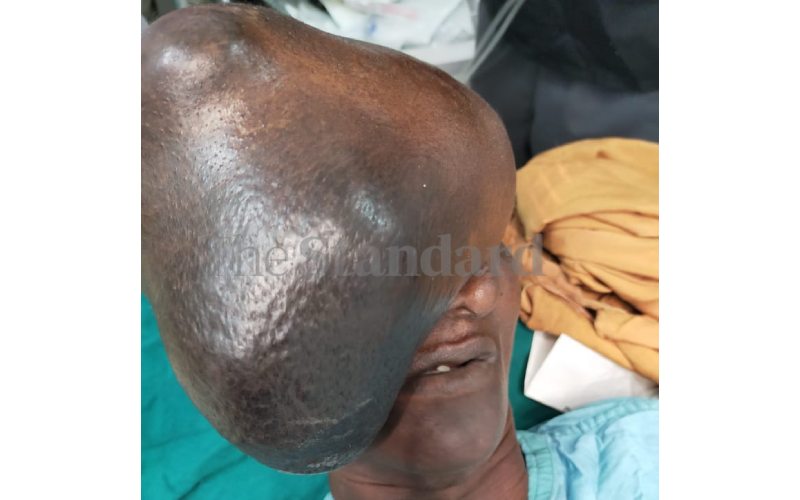 Doctors remove cyst with 3 litres of fluid from woman s face