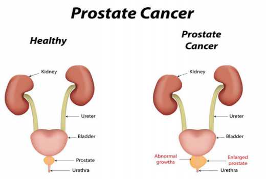 1000 cases of Prostate cancer reported each year