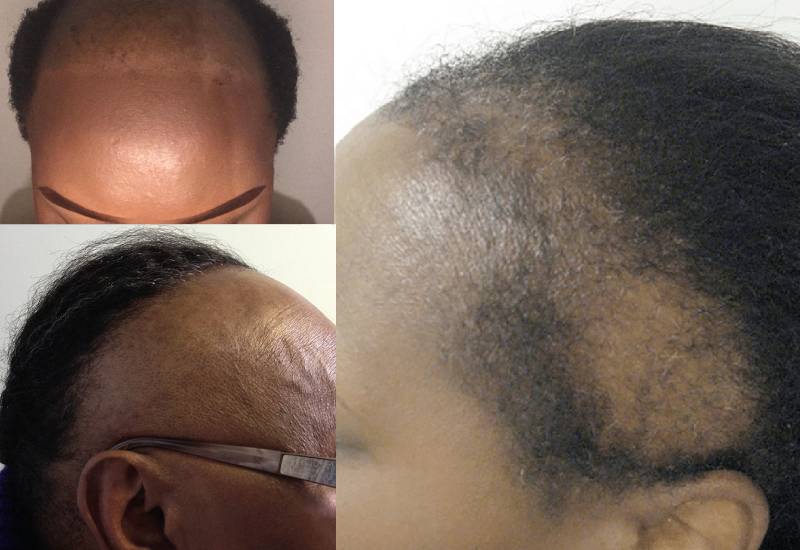 Finally, you can say goodbye to baldness - The Standard Evewoman Magazine