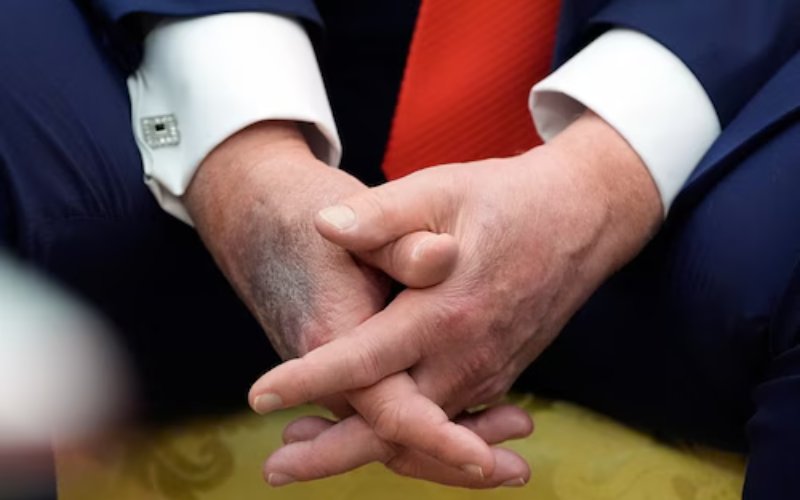 Bruises on Donald Trump's right hand elicit concern over his health