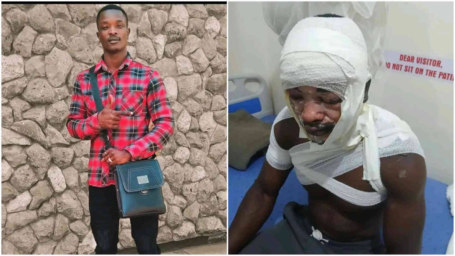 Multimedia University student burnt, Sh300,000 allegedly stolen by girlfriend