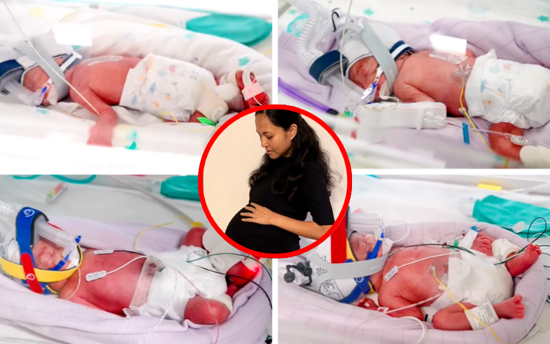 1 in 15 million: Woman welcomes rare quadruplets sharing single placenta