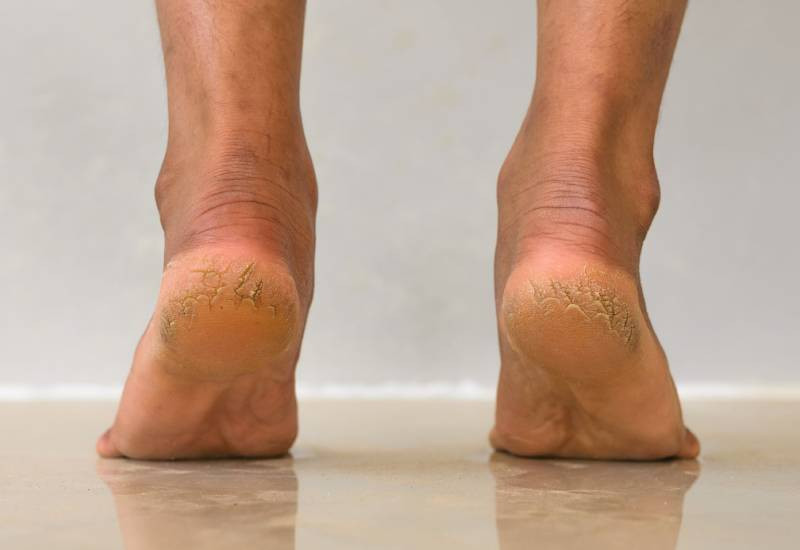 Painful Cracked Heels? Here Are 5 Tips To Avoid Them