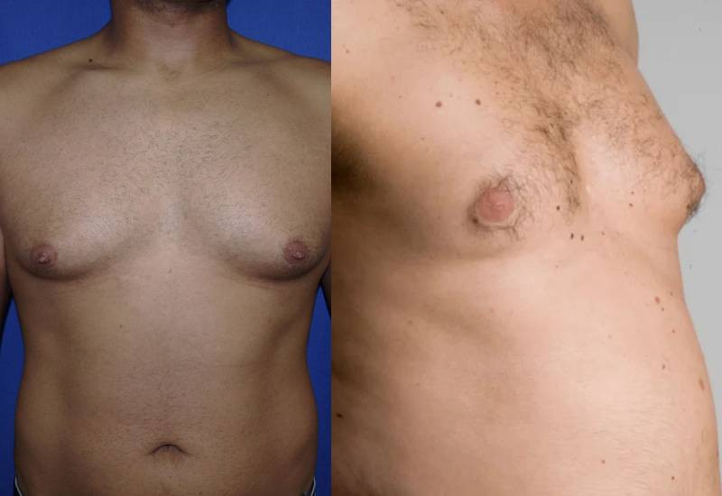 How to get rid of man boobs - The Standard Health