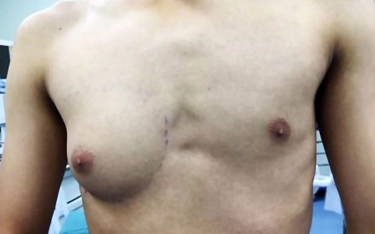 Men, say no to fried chicken: Teenager grows A-cup breast because